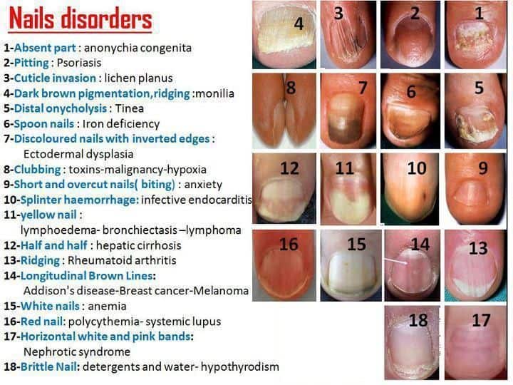 what are fingernail and toenail abnormalities?